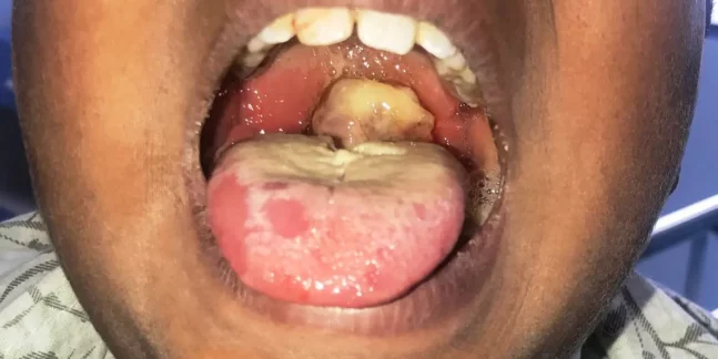 Diphtheria Outbreak Claims 10 Children in Niger State